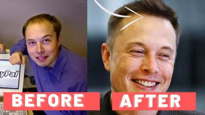 Was Elon Musk Bald How Did Elon Musk Grow His Hair Back 8563